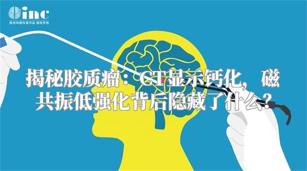 揭秘胶质瘤：CT显示钙化，磁共振低强化背后隐藏了什么？