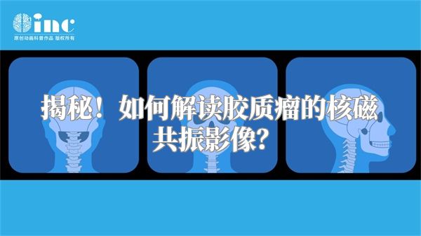 揭秘！如何解读胶质瘤的核磁共振影像？
