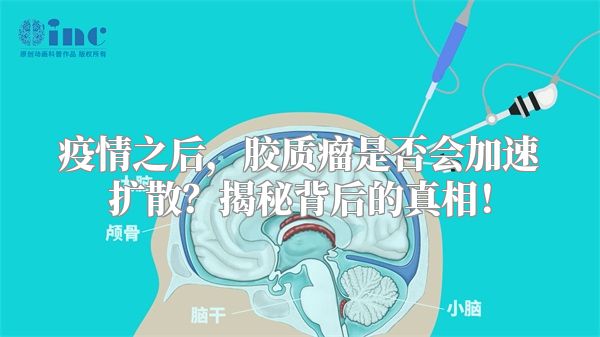 疫情之后，胶质瘤是否会加速扩散？揭秘背后的真相！