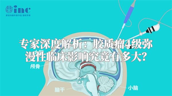 专家深度解析：胶质瘤4级弥漫性临床影响究竟有多大？
