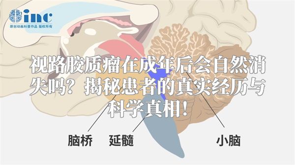 视路胶质瘤在成年后会自然消失吗？揭秘患者的真实经历与科学真相！