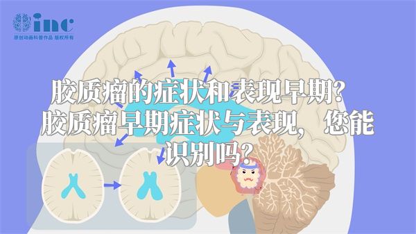 胶质瘤的症状和表现早期？ 胶质瘤早期症状与表现，您能识别吗？
