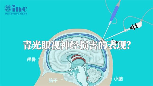 青光眼视神经损害的表现？