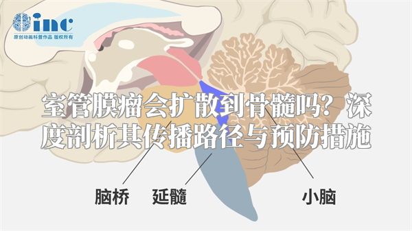室管膜瘤会扩散到骨髓吗？深度剖析其传播路径与预防措施