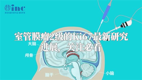 室管膜瘤2级的Ki67最新研究进展，关注必看
