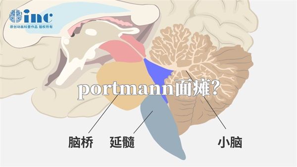 portmann面瘫？