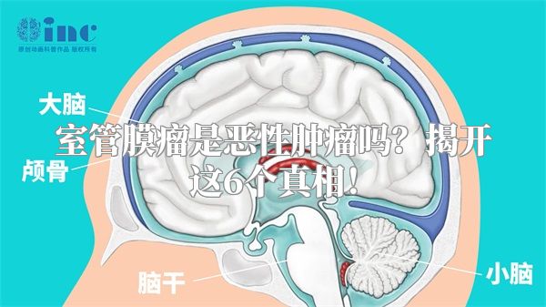 室管膜瘤是恶性肿瘤吗？揭开这6个真相！