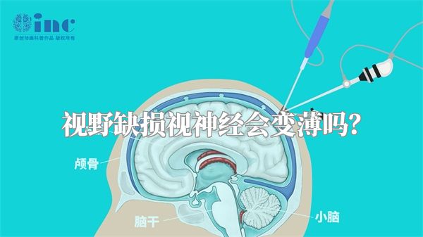 视野缺损视神经会变薄吗?