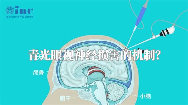 青光眼视神经损害的机制？