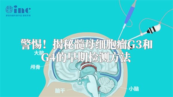 警惕！揭秘髓母细胞瘤G3和G4的早期检测方法