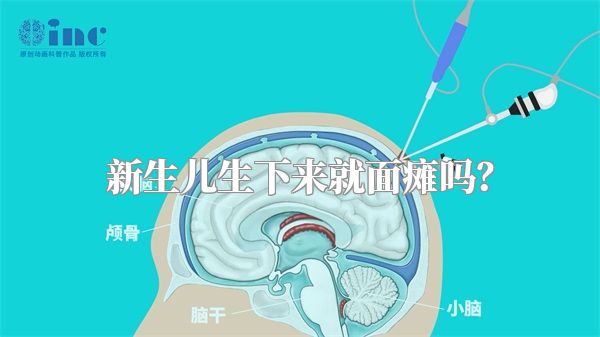 新生儿生下来就面瘫吗？