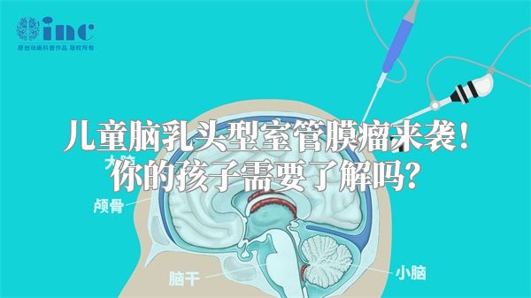 儿童脑乳头型室管膜瘤来袭！你的孩子需要了解吗？