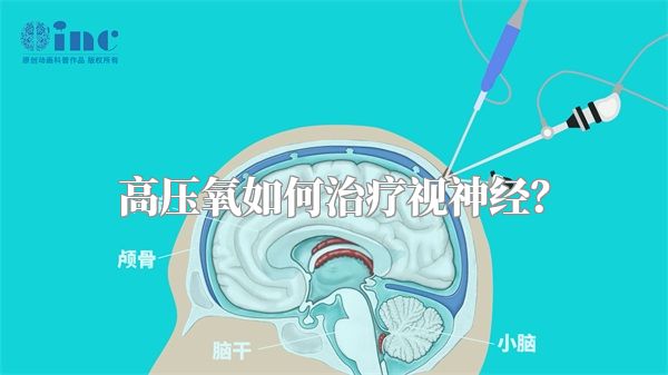 高压氧如何治疗视神经？