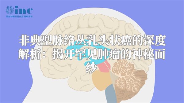 非典型脉络丛乳头状癌的深度解析：揭开罕见肿瘤的神秘面纱