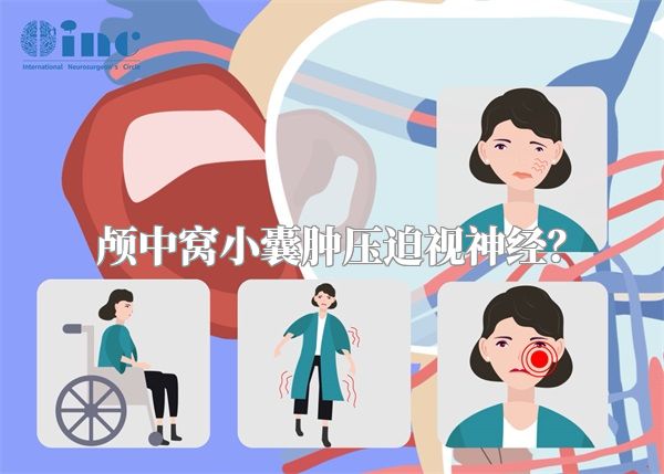 颅中窝小囊肿压迫视神经？