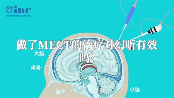 做了MECT的治疗对幻听有效吗？