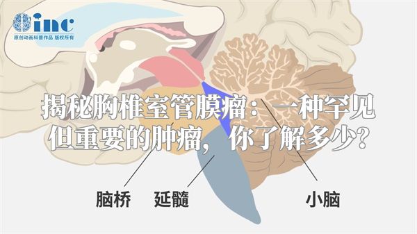 揭秘胸椎室管膜瘤：一种罕见但重要的肿瘤，你了解多少？