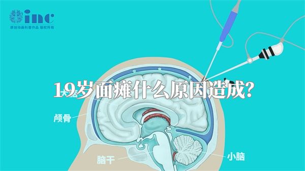 19岁面瘫什么原因造成？