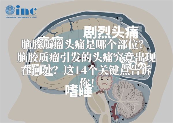 脑胶质瘤头痛是哪个部位？ 脑胶质瘤引发的头痛究竟出现在何处？这14个关键点告诉你！