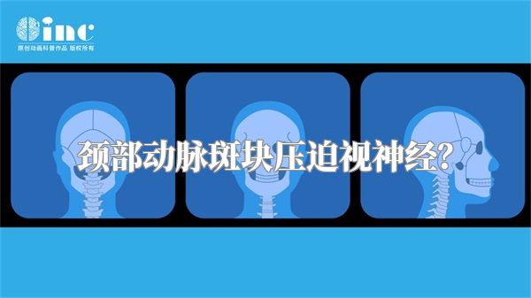 颈部动脉斑块压迫视神经？