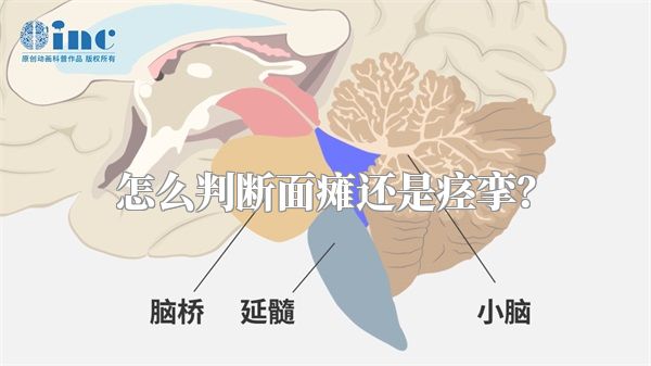 怎么判断面瘫还是痉挛？