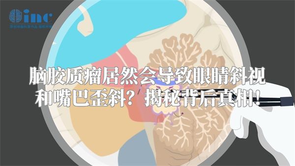 脑胶质瘤居然会导致眼睛斜视和嘴巴歪斜？揭秘背后真相！