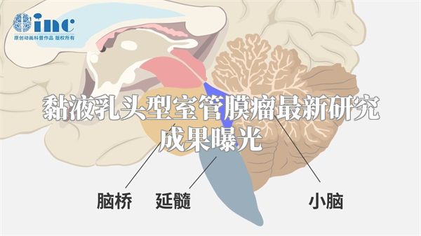 黏液乳头型室管膜瘤最新研究成果曝光