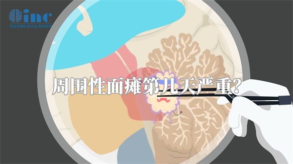 周围性面瘫第几天严重？