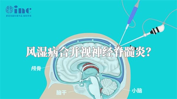 风湿病合并视神经脊髓炎?
