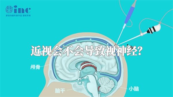 近视会不会导致视神经?