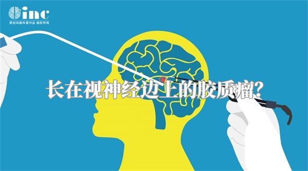长在视神经边上的胶质瘤？