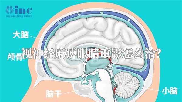 视神经麻痹眼睛重影怎么治？
