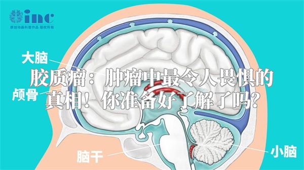 胶质瘤：肿瘤中最令人畏惧的真相！你准备好了解了吗？
