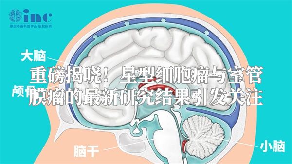 重磅揭晓！星型细胞瘤与室管膜瘤的最新研究结果引发关注
