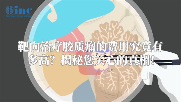 靶向治疗胶质瘤的费用究竟有多高？揭秘您关心的真相！
