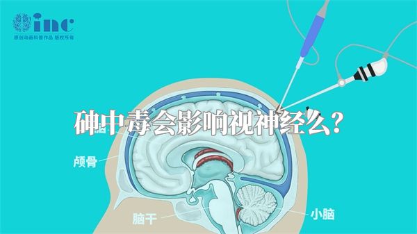 砷中毒会影响视神经么？