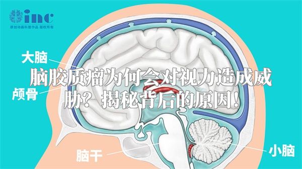 脑胶质瘤为何会对视力造成威胁？揭秘背后的原因！