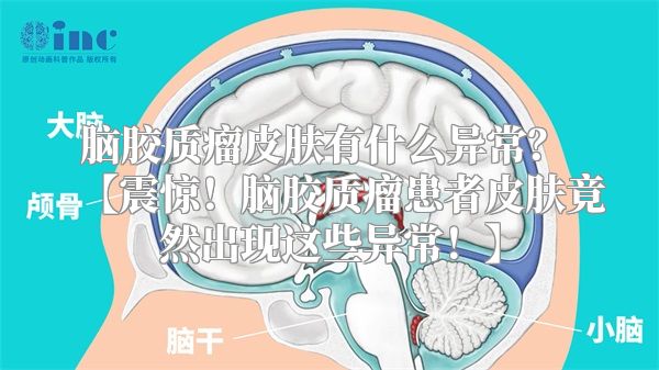 脑胶质瘤皮肤有什么异常？ 【震惊！脑胶质瘤患者皮肤竟然出现这些异常！】