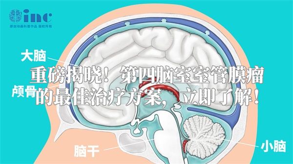 重磅揭晓！第四脑室室管膜瘤的最佳治疗方案，立即了解！