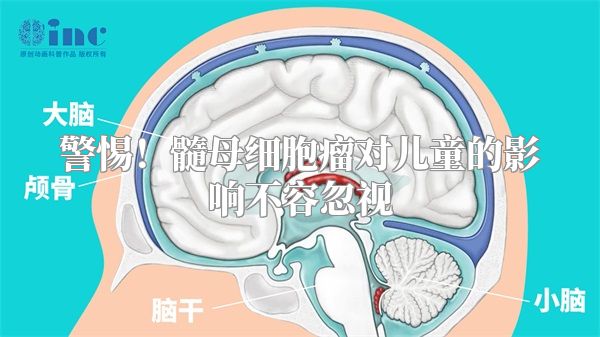 警惕！髓母细胞瘤对儿童的影响不容忽视