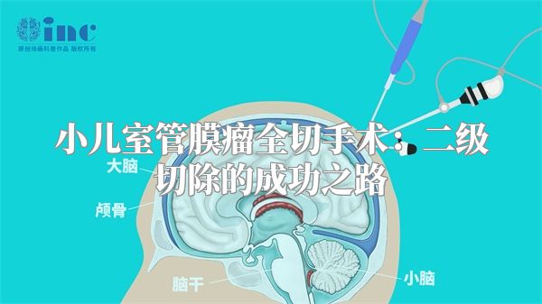 小儿室管膜瘤全切手术：二级切除的成功之路