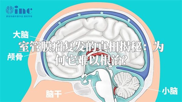 室管膜瘤复发的真相揭秘：为何它难以根治？