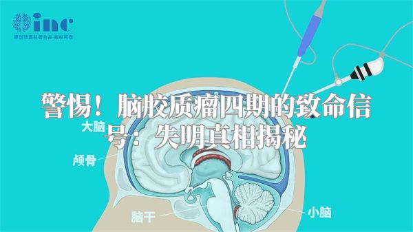 警惕！脑胶质瘤四期的致命信号：失明真相揭秘