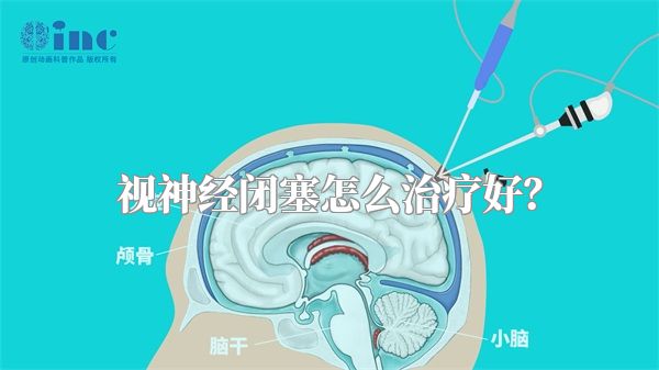 视神经闭塞怎么治疗好？