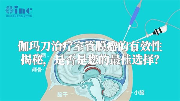 伽玛刀治疗室管膜瘤的有效性揭秘，是否是您的最佳选择？