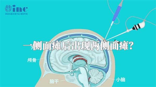一侧面瘫后出现两侧面瘫？