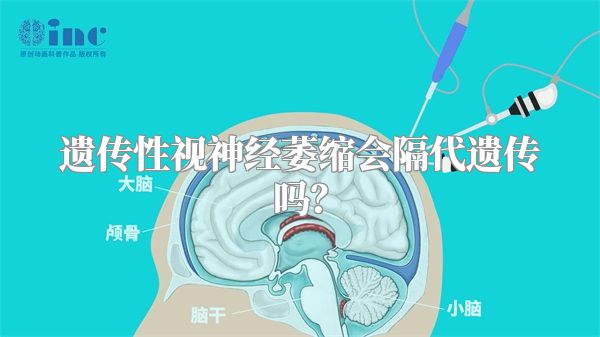 遗传性视神经萎缩会隔代遗传吗？