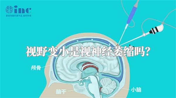 视野变小是视神经萎缩吗？