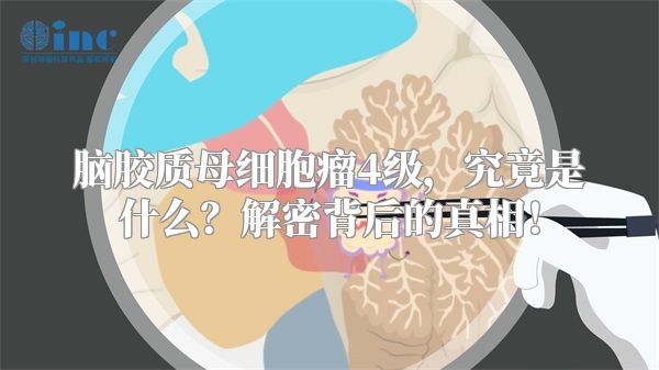 脑胶质母细胞瘤4级，究竟是什么？解密背后的真相！