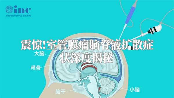 震惊!室管膜瘤脑脊液扩散症状深度揭秘